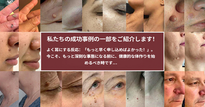 ✨Curalona® 2-in-1 マイクロニードル＆ハイドロコロイドパッチ🍀 | 隆起したほくろ、ニキビ、扁平イボ、皮膚線維腫を除去 | シワ、傷跡、肌の気になる部分の改善をサポート | 顔や体に使える目立たないパッチ