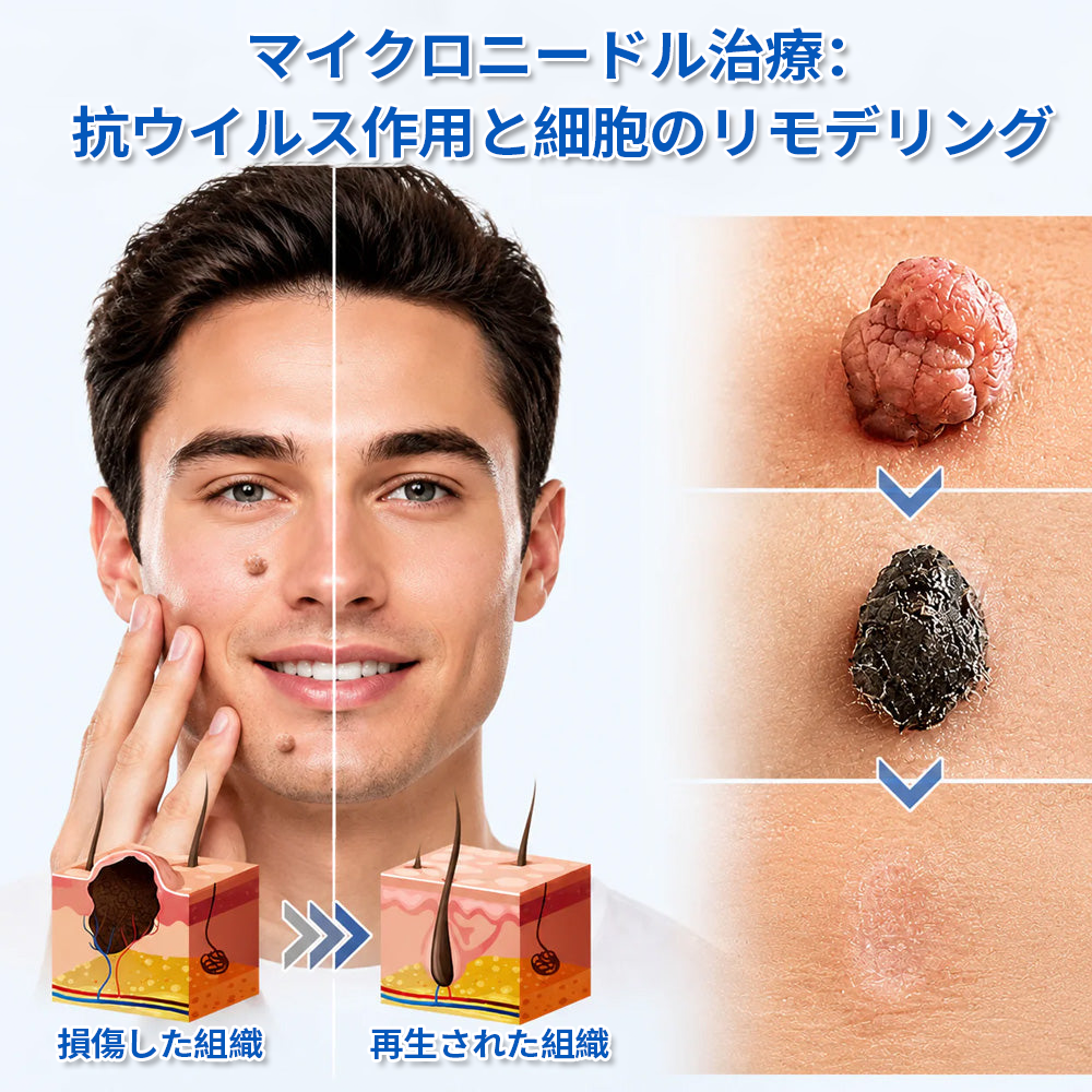 ✨Curalona® 2-in-1 マイクロニードル＆ハイドロコロイドパッチ🍀 | 隆起したほくろ、ニキビ、扁平イボ、皮膚線維腫を除去 | シワ、傷跡、肌の気になる部分の改善をサポート | 顔や体に使える目立たないパッチ