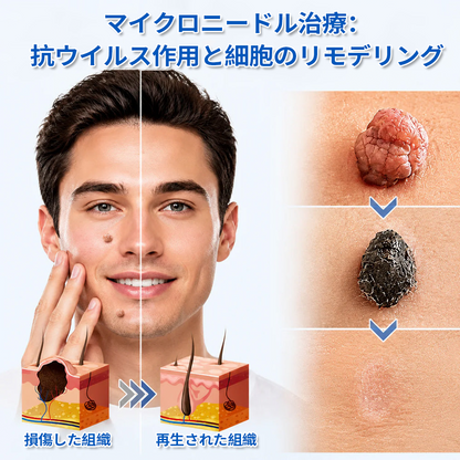 ✨Curalona® 2-in-1 マイクロニードル＆ハイドロコロイドパッチ🍀 | 隆起したほくろ、ニキビ、扁平イボ、皮膚線維腫を除去 | シワ、傷跡、肌の気になる部分の改善をサポート | 顔や体に使える目立たないパッチ